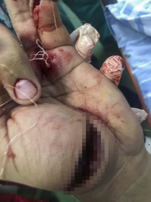 Bebino a ajuns pe masa de operație, cu răni grave
