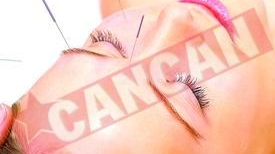 Cand va doare capul faceti acupunctura!