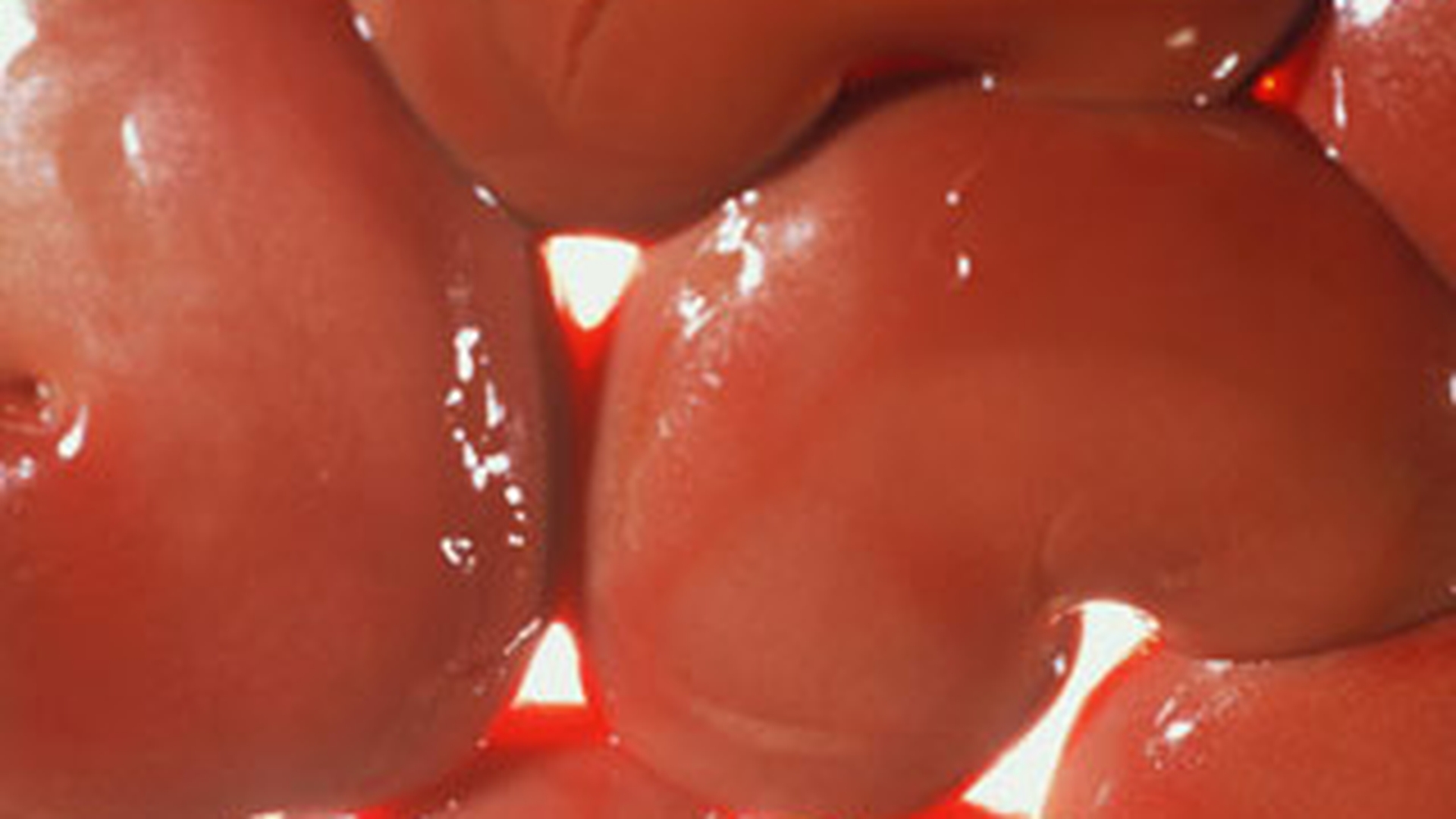 Rinichii romanilor saraci, transplantati ilegal intr-o clinica din Africa de Sud