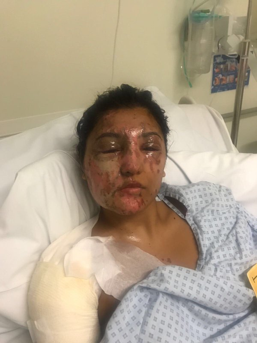 VIDEO / Voia să ajungă manechin celebru, dar soarta a lovit-o crunt! I-a aruncat cu acid sulfuric în faţă şi a distrus-o! Ce a făcut apoi agresorul