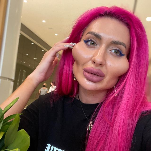 Cum a ajuns să arate o femeie dependentă de botox! Doctorii i-au spus să se oprească