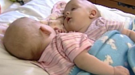 Acum 10 ani, doctorii au încercat să separe cele două siameze! Cum arată fetiţele acum 