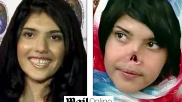 Fata care a sfidat Islamul si a fost mutilata de sotul ei are sansa unei vieti normale! Medicii i-ar refacut chipul