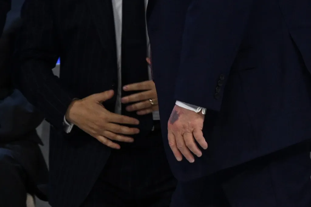 Imagine alarmantă cu Donald Trump: a apărut în public cu ceea ce pare a fi o rană roșie la gât