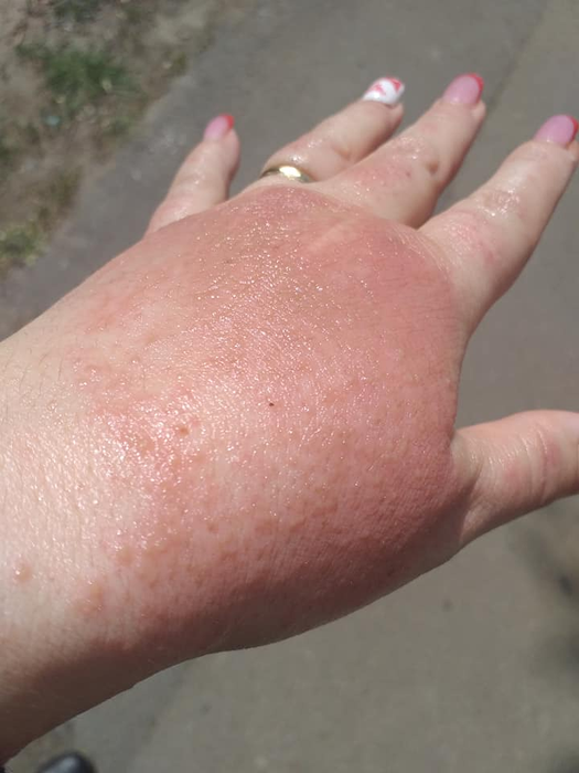 Imagini ireale! Ce a pățit o femeie după ce s-a spălat cu dezinfectant într-un supermarket din Brăila