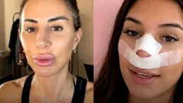 Val de reacții după ce o influenceriță s-a operat, pentru ca viitorii copii să nu îi moștenească nasul