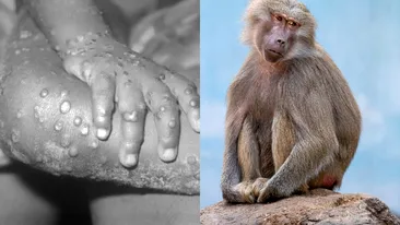 Spania începe vaccinarea împotriva variolei maimuței. Care sunt simptomele care ar trebui să te trimită la medic