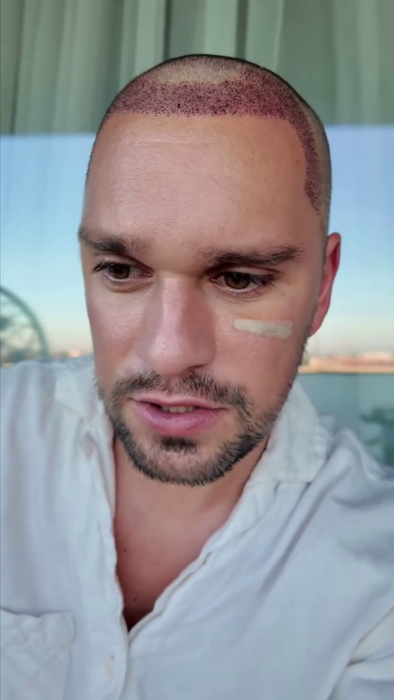Vlad Gherman, după implantul de păr/ Sursa foto: Instagram