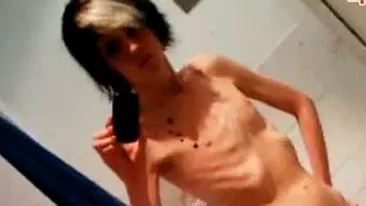 VIDEO Un tanar anorexic din Marea Britanie: Eram atat de subnutrit, incat propriul meu corp incepuse sa se manance pe interior