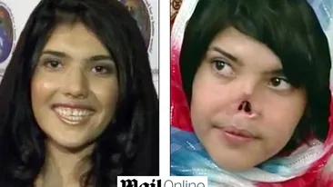 Fata care a sfidat Islamul si a fost mutilata de sotul ei are sansa unei vieti normale! Medicii i-ar refacut chipul