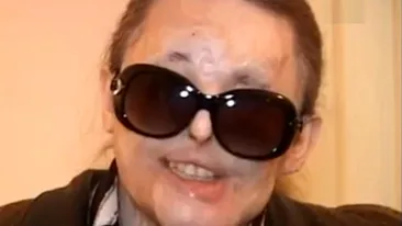 Drama halucinanta a unei romance! La 5 ani dupa ce a fost desfigurata cu acid sulfuric, destinul ii e din ce in ce mai potrivnic