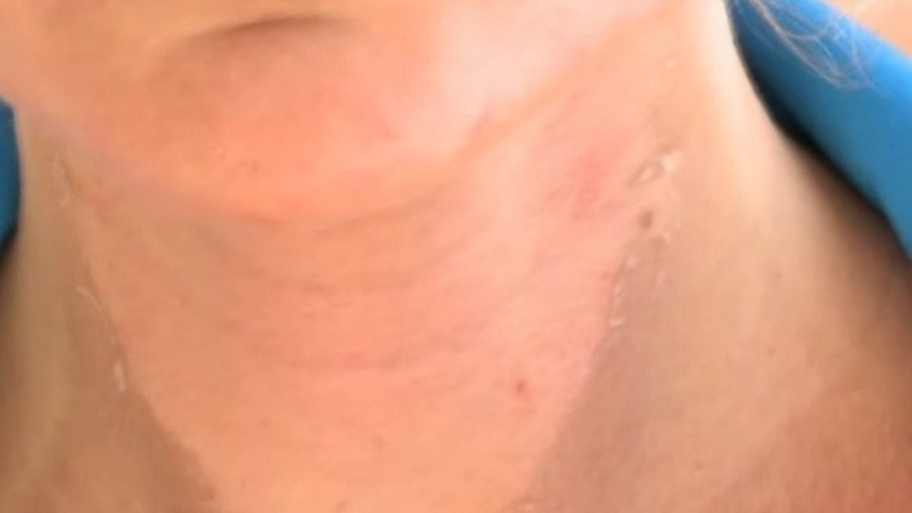 IMAGINI HORROR! Cum a ajuns sa arate o romanca dupa ce a mers la solar. Si-a ars fata si pieptul