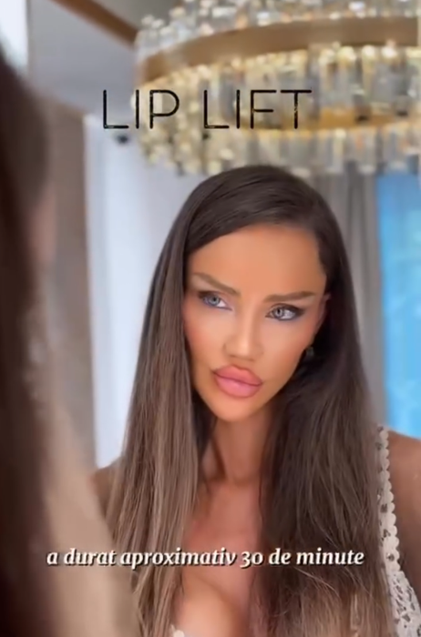 Cum arată Bianca Drăgușanu după intervenția de lip lift. A trecut aproape o lună de când și-a modificat buzele