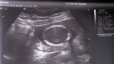 Este incredibil ce i-au gasit unei femei de 82 de ani in burta! Medici au ramas fara cuvinte