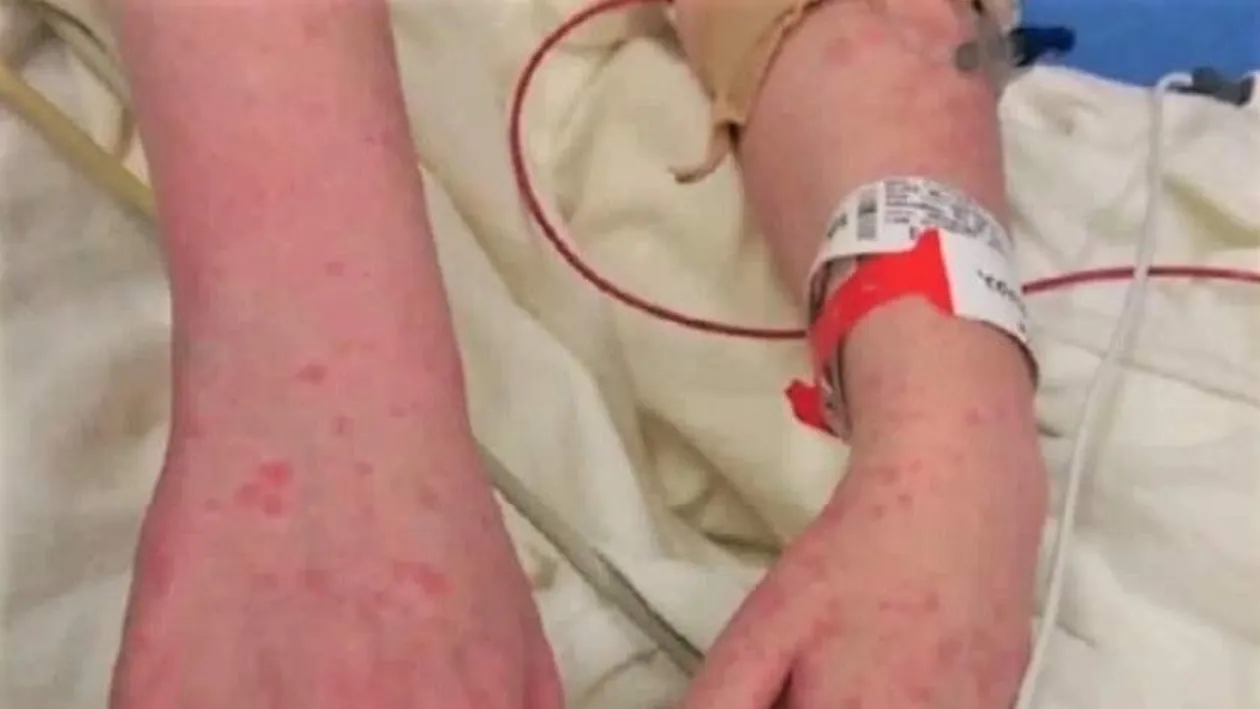 O boală care poate fi mortală a fost descoperită la Bacău. În primă fază, afecţiunea se manifestă ca o gripă banală