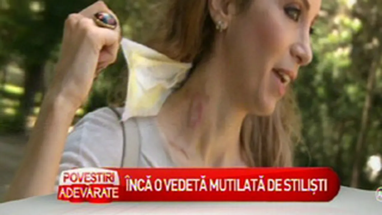 Dupa ce a fost arsa pe gat cu ondulatorul, Annes se gandeste sa-si faca un tatuaj pentru a acoperi cicatricea
