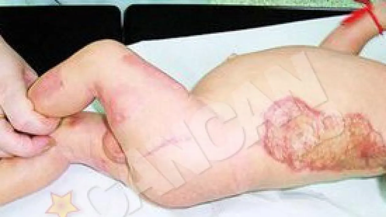 Parintii copilului ars in incubator ar putea primi 450.000 de euro!