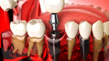 Cât rezistă un implant dentar? Află durata medie de viață