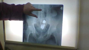 Șocant. Un tânăr din Olt a ajuns la Urgență după un ”accident casnic” ciudat: ”Mama lui a spus că...”