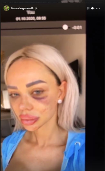 Bianca Drăgușanu a arătat din greșeală înregistrarea cutremurătoare în care este leșinată lângă pat: “Am trăit în casă cu un om care mă filma non stop! Nu ți se pare că ăsta e șantaj?!”