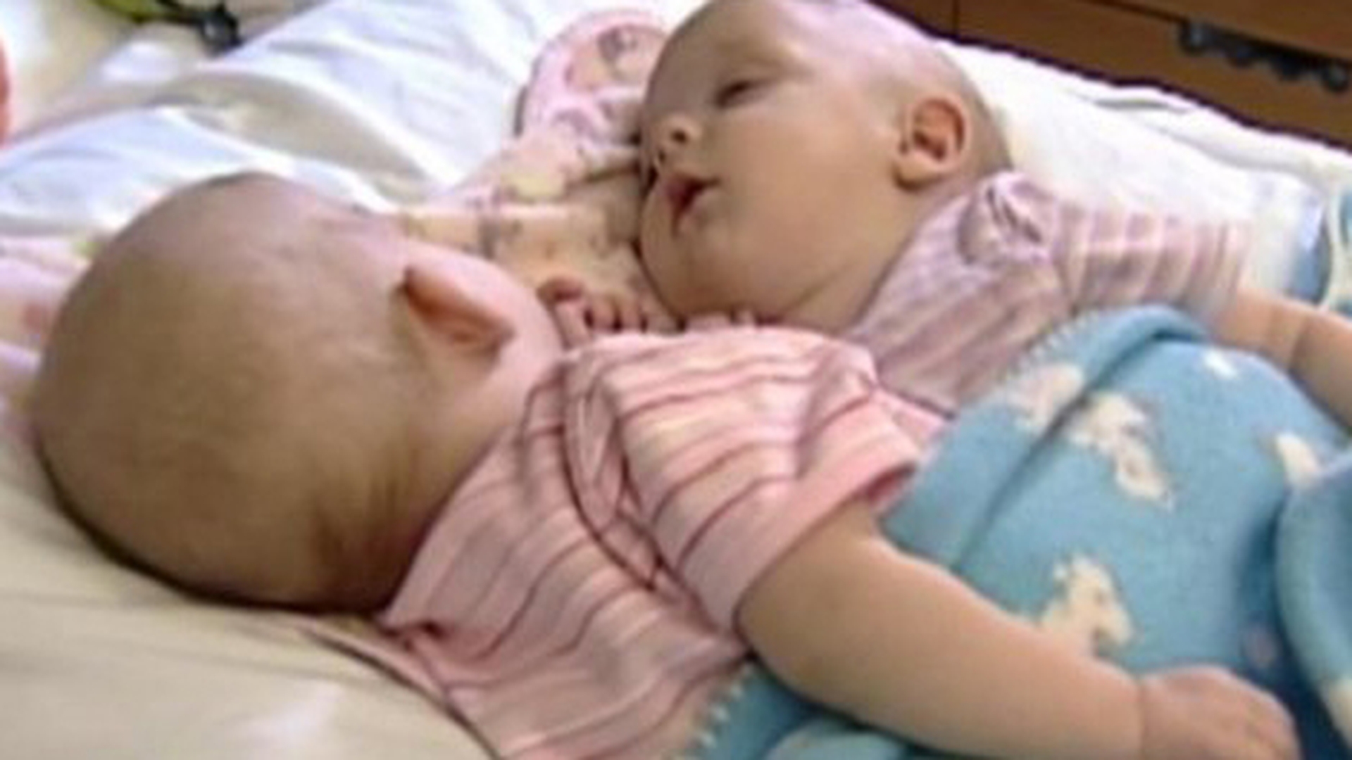 Acum 10 ani, doctorii au încercat să separe cele două siameze! Cum arată fetiţele acum 