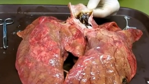 Asa arata plamanii dupa doar doua pachete de tigari! Iti imaginezi cum arata cei ai unui fumator inrait?