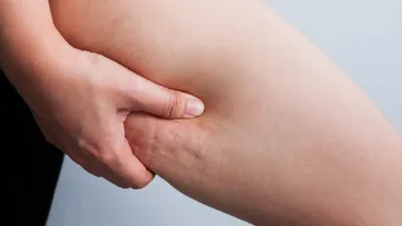 Alimentele interzise în lupta cu celulita. Specialiștii atrag atenția