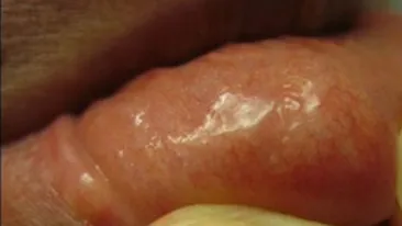 Totul a inceput cand i s-a UMFLAT buza! Ce a descoperit ca TRAIESTE in gura lui cand si-a taiat pielea