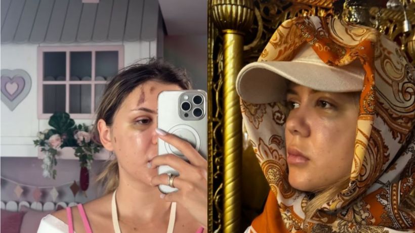 Coșmarul trăit de Emily Burghelea de când s-a operat de urgență: „Simt fierul din cap, simt cum se mișcă” VIDEO