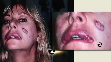 Le-a iesit siliconul prin carne, ori li s-a scurs acidul prin piele! Topul cele mai nereusite operatii estetice din lume!