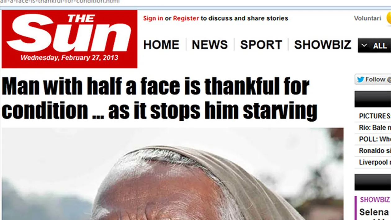 Imagini şocante! Un bărbat transfigurat de o boală rară este recunoscător pentru asta - datorită bolii am ce mânca