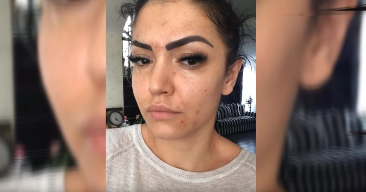 Andreea Mantea, imagini șocante. Vedetei Kanal D i-au ieșit bube pe față