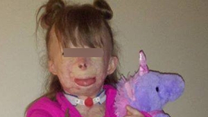 O fetita de 8 ani a fost mutilata de flacari! Cazul sau a impresionat o celebra vedeta