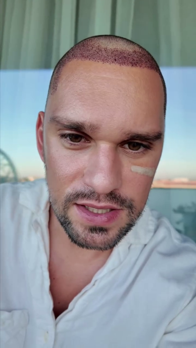 Vlad Gherman, după implantul de păr/ Sursa foto: Instagram