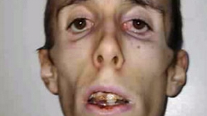 Cea mai socanta imagine a ANOREXIEI. "Cantaream 28 kg si fost mort timp de 20 de minute". Cum arata astazi tanarul din imagine