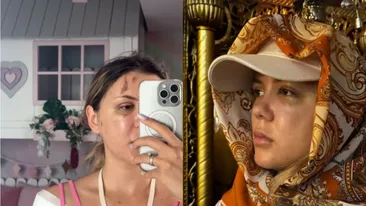 Coșmarul trăit de Emily Burghelea de când s-a operat de urgență: „Simt fierul din cap, simt cum se mișcă” VIDEO