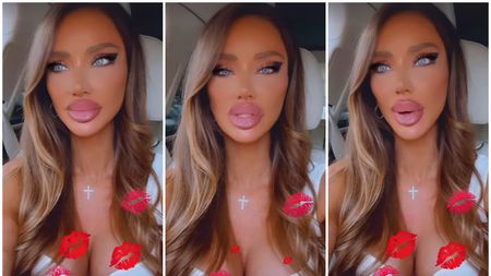 De ce își topește Bianca Drăgușanu acidul din buze. Vedeta a recunoscut ce s-a întâmplat