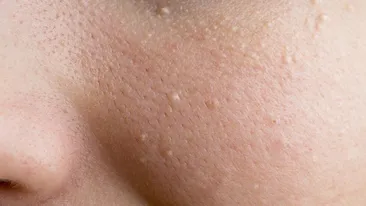 Cum poţi scăpa de punctele albe de pe ten. Reţeta care face minuni
