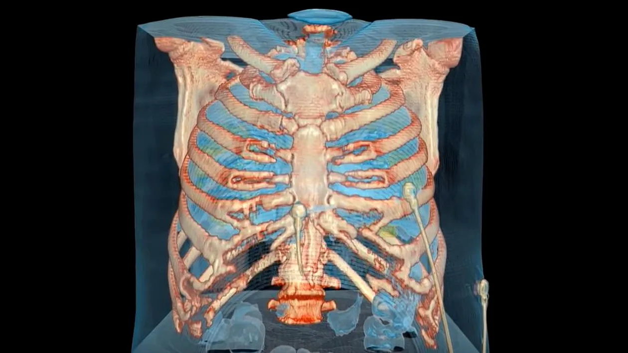 Imagini înspăimântătoare. Cum distruge noul coronavirus un plămân. VIDEO 3D
