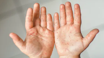 Sute de cazuri de „gură-mână-picior” în creșele și grădinițele dintr-un oraș mare din România. Boala nu are tratament, iar copiii trebuie izolați