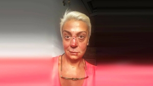 Monica Anghel, desfigurată! NU e machiaj şi nici Photoshop: a povestit ce i s-a întâmplat