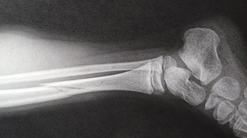 Neglijenţa cadrelor medicale poate fi fatală!O fetiţă de 4 ani a murit în urma unei fracturi la picior!
