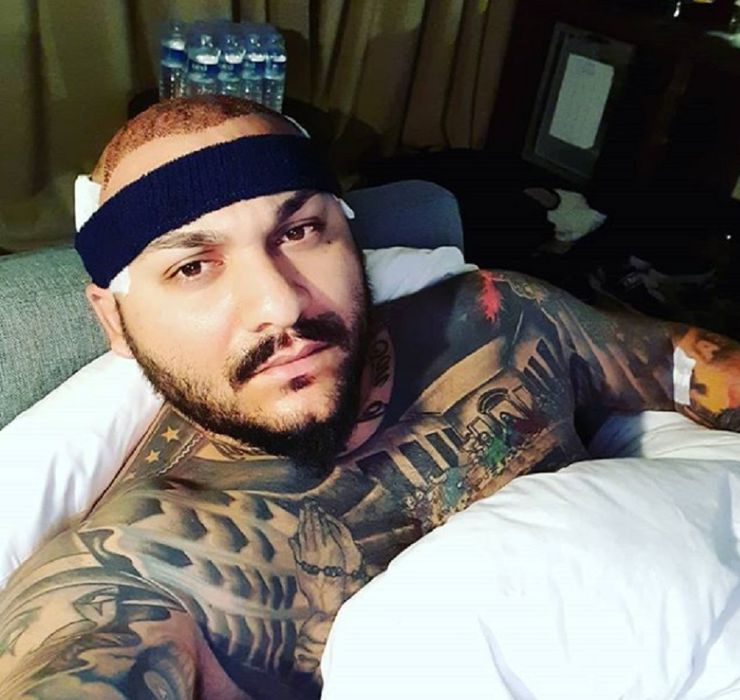 Dani Mocanu, dupa implantul de par