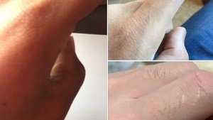 Ce înseamnă dacă ai o cicatrice pe degetul de la mâna stângă: „Persoana care te-a iubit în viața anterioară nu....”