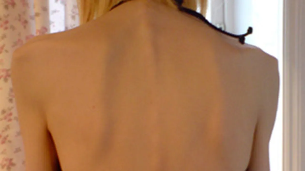 Uite in ce hal arata o adolescenta anorexica! Are 30 de kilograme si mananca doar bomboane fara zahar