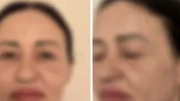 Cum se apără medicul estetician în cazul femeii aflată în moarte cerebrală, după un lifting facial! Imagini șocante cu Valentina