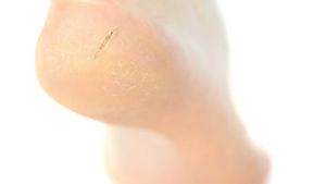 Călcâie crăpate? 5 remedii și vei uita de călcâiele crăpate și dureroase