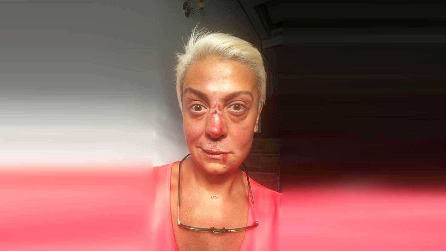 Monica Anghel, desfigurată! NU e machiaj şi nici Photoshop: a povestit ce i s-a întâmplat