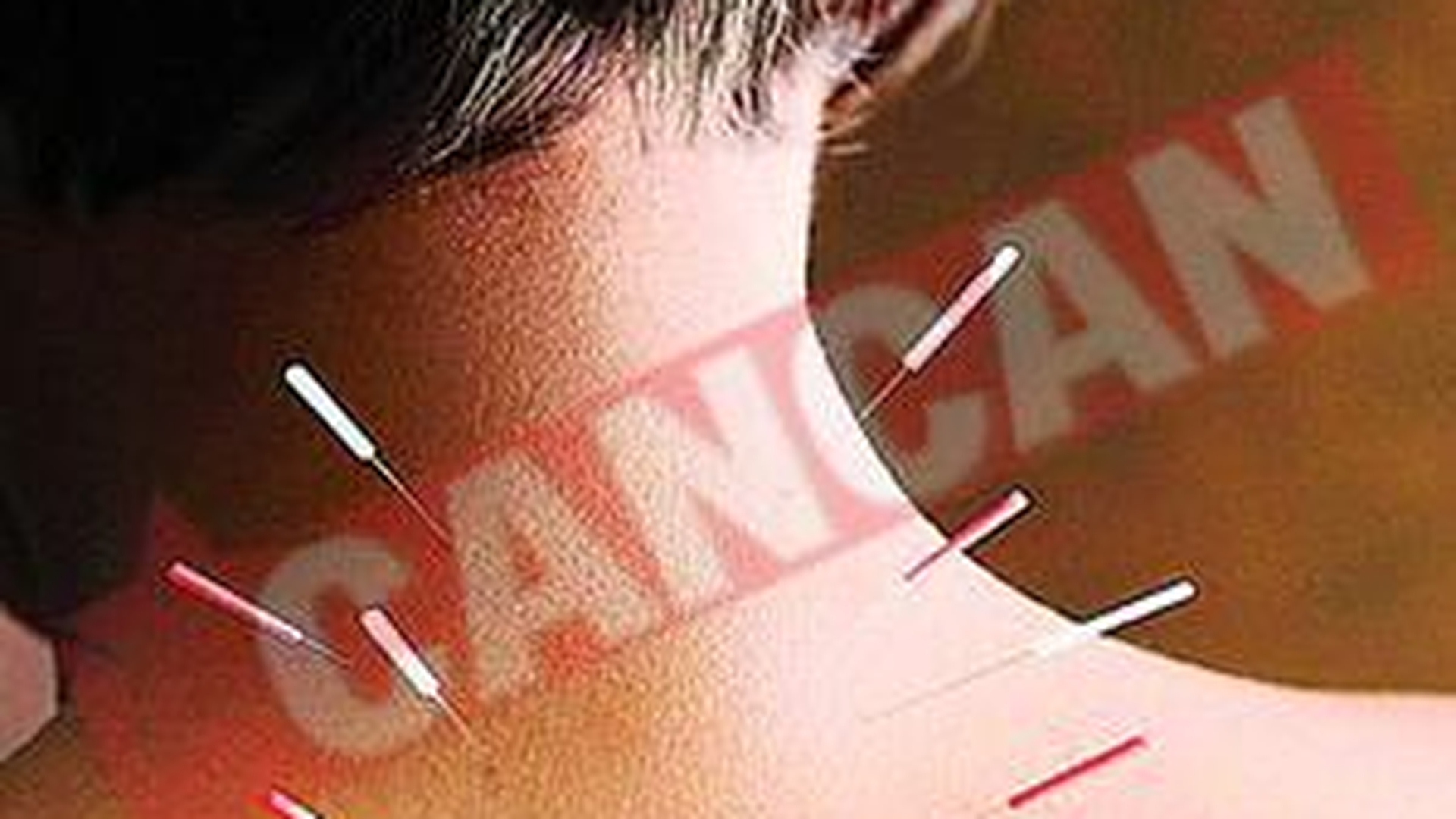 Ce boli se pot vindeca prin acupunctura