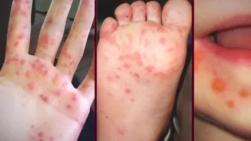Atenție. Boala numită „Gură-mână-picior” face ravagii în România